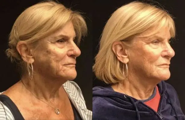 Deep plane facelift before-and-after result — DEEPPLANE™