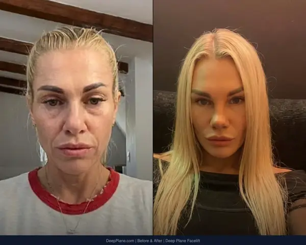 Deep Plane Facelift result by Dr. Yakup Duman